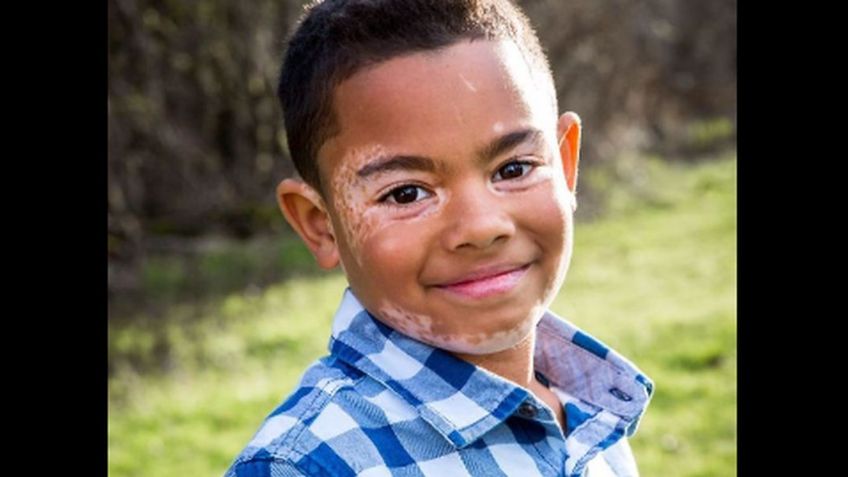 Niño con vitiligo se curó de profunda depresión al conocer a un perro con su misma enfermedad