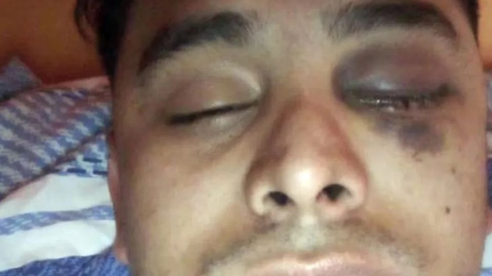 Joven argentino perdió ojo por atrasarse en el pago del alquiler.