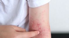 La dermatitis atópica, una enfermedad crónica que afecta a millones de mexicanosa