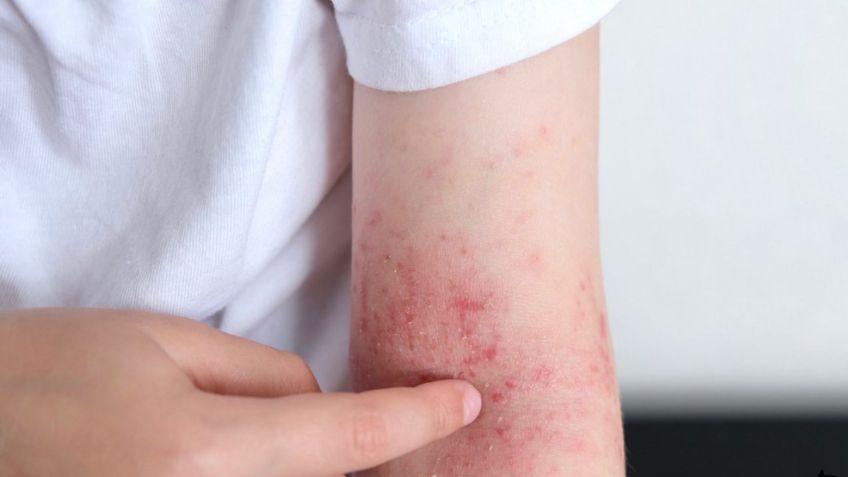 La dermatitis atópica, una enfermedad crónica que afecta a millones de mexicanosa