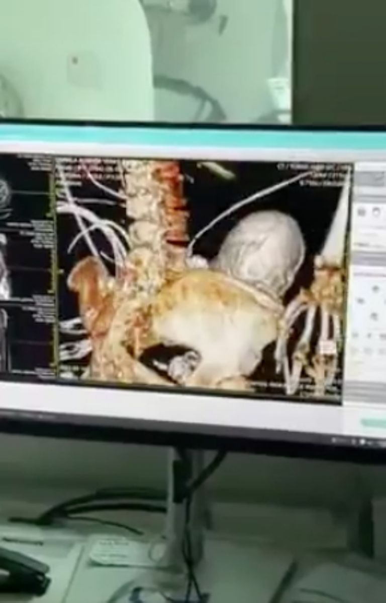 bebe calcificado