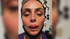 Ivonne Montero sufre reacción alérgica y termina con los labios hinchados: "soy Kardashian"