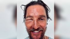 Matthew McConaughey impacta por el aspecto de su rostro tras ser picado por una abeja