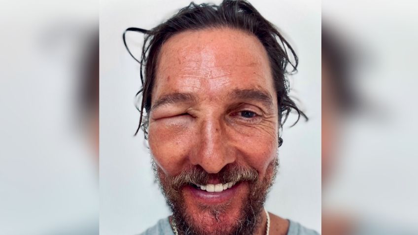 Matthew McConaughey impacta por el aspecto de su rostro tras ser picado por una abeja