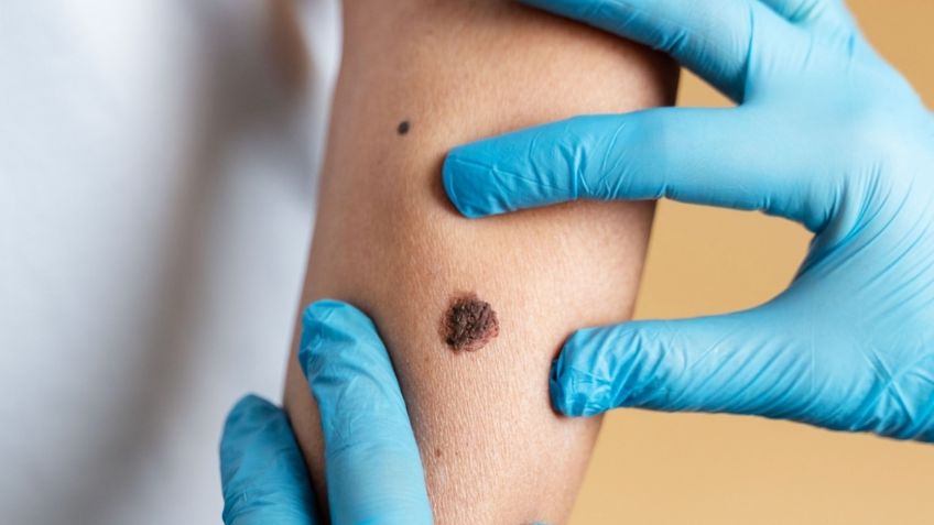 Cofepris aprueba ensayo clínico para vacuna innovadora contra melanoma