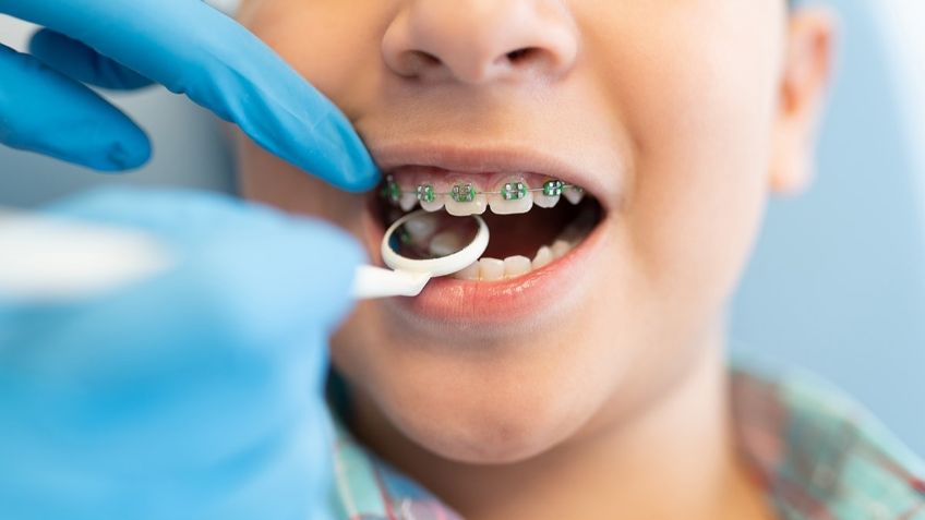 ¿Cuánto cuesta ponerse brackets? Esto debes pagar para arreglarte los dientes