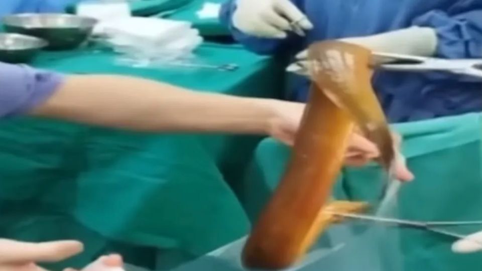 Extraen una anguila del intestino de un hombre.