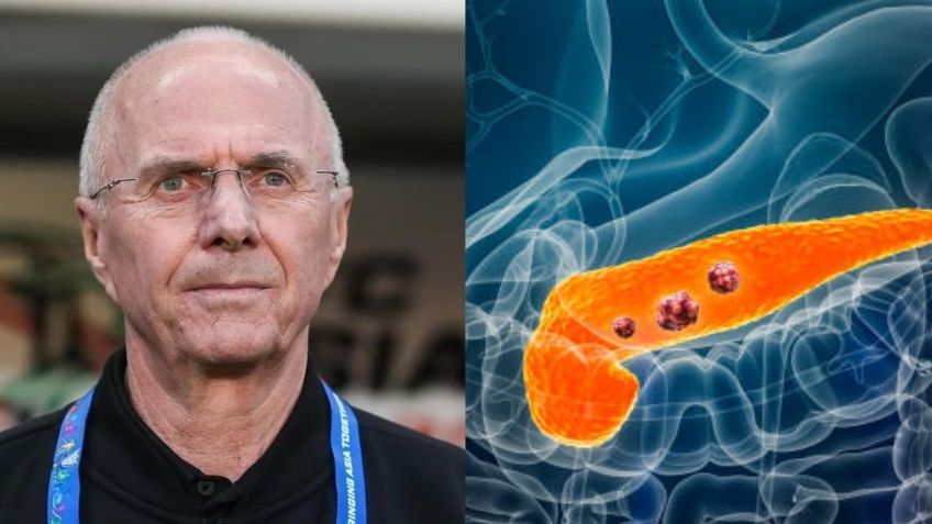 ¿Qué es el cáncer de páncreas, principales causas y síntomas de la enfermedad que mató a Sven-Göran Eriksson?