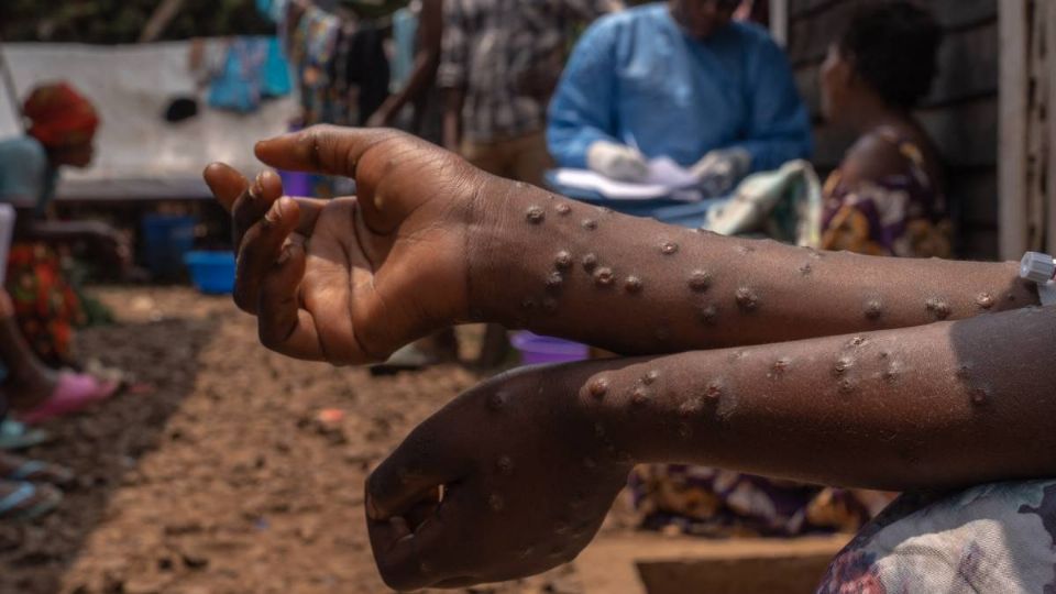 El virus mpox preocupa a los expertos médicos en África.