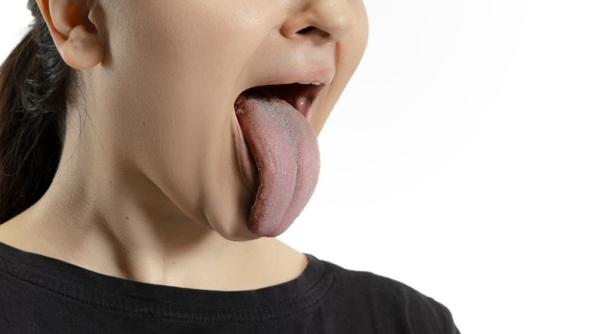 ¿Tienes la lengua blanca? Estas pueden ser las causas y así puedes prevenirlo