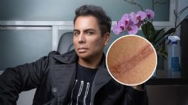 Foto que representa a ¿Qué hacer para eliminar las cicatrices? Javi Derma, el famosos dermatólogo, comparte sus mejores recomendaciones